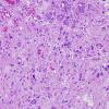 2A4 Pleomorphic Xanthoastrocytoma (Case 2) H&E 15 (2)