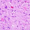 2A5 Pleomorphic Xanthoastrocytoma (Case 2) H&E 2