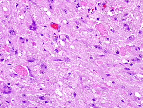 2A5 Pleomorphic Xanthoastrocytoma (Case 2) H&E 2