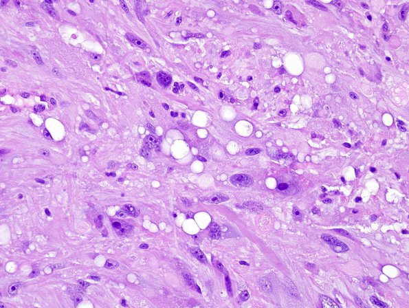 2A7 Pleomorphic Xanthoastrocytoma (Case 2) H&E 6