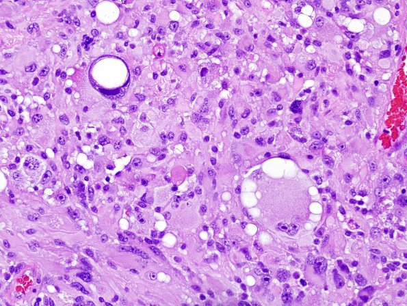 2A8 Pleomorphic Xanthoastrocytoma (Case 2) H&E 10