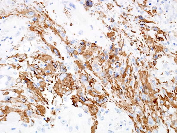 2B2 Pleomorphic Xanthoastrocytoma (Case 2) GFAP 5