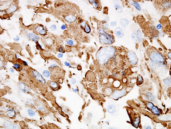 2B3 Pleomorphic Xanthoastrocytoma (Case 2) GFAP 3