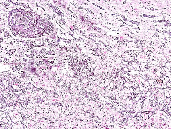 2C Pleomorphic Xanthoastrocytoma (Case 2) Retic 1