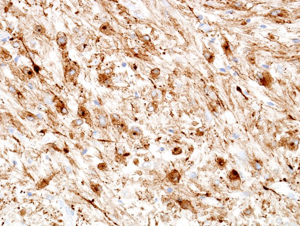 2D Pleomorphic Xanthoastrocytoma (Case 2) SYN 9