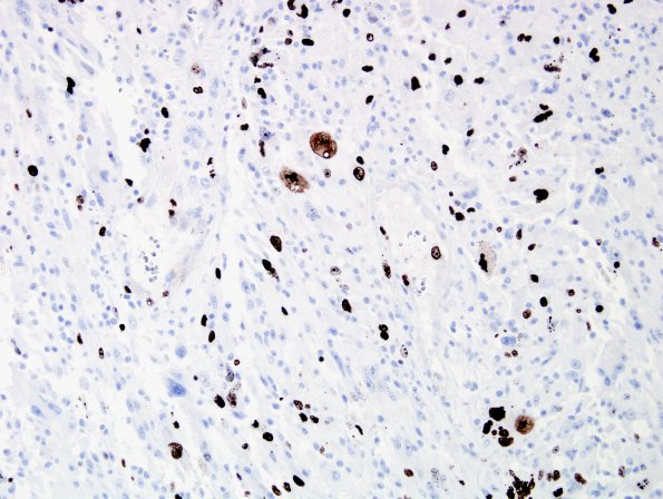 2E Pleomorphic Xanthoastrocytoma (Case 2) Ki67 2