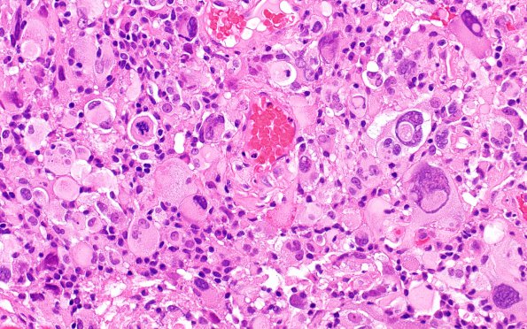 3A8 PXA, anaplastic (Case 3) H&E 2