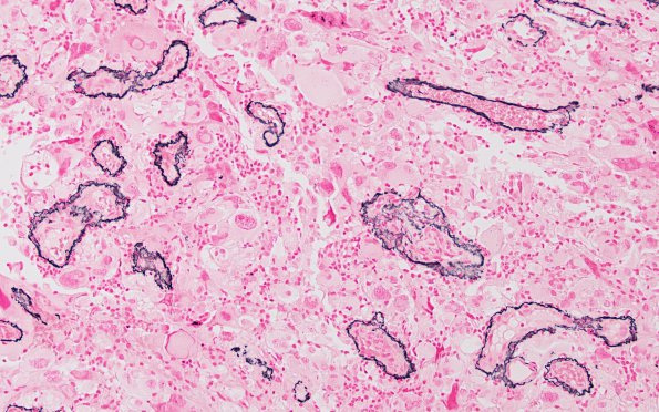 3D PXA, anaplastic (Case 3) Retic