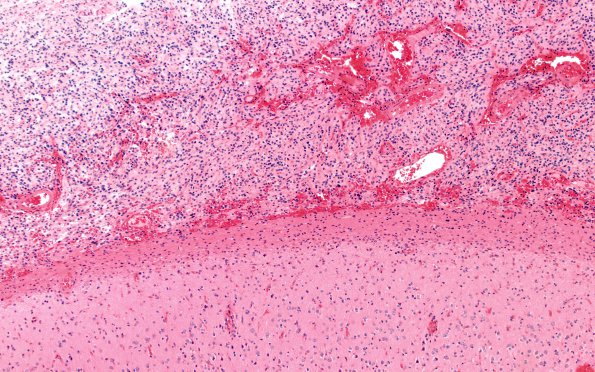 4A1 PLeomorphic xanthoastrocytoma (Case 4) H&E B3 10X