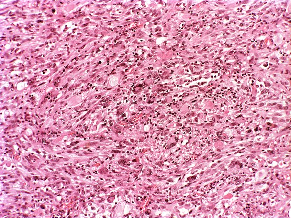 4A2 Pleomorphic xanthoastrocytoma (Case 4) H&E 8