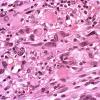 4A3 Pleomorphic xanthoastrocytoma (Case 4) H&E 6