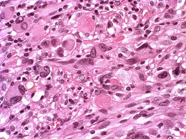 4A3 Pleomorphic xanthoastrocytoma (Case 4) H&E 6