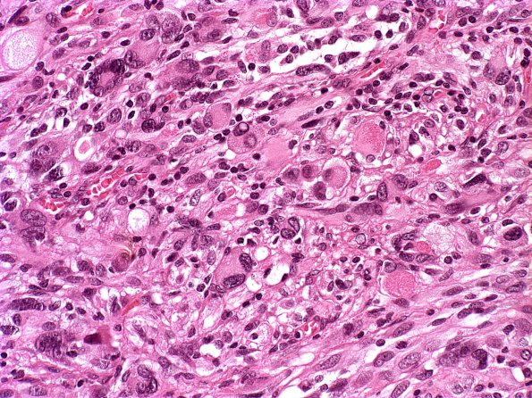 4A3 Pleomorphic xanthoastrocytoma (Case 4) H&E 7