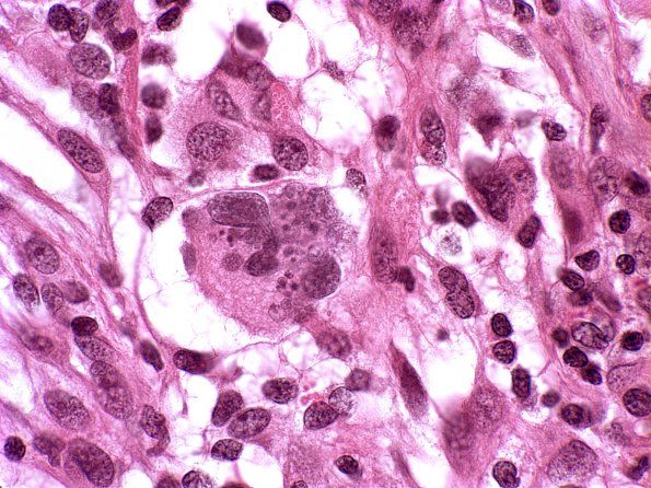 4A4 Pleomorphic xanthoastrocytoma (Case 4) H&E 4