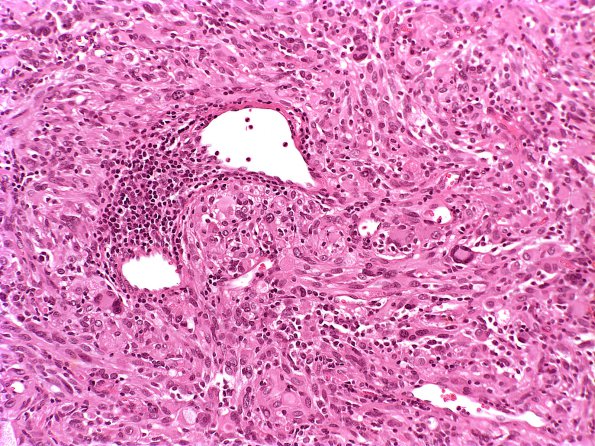 4A5 Pleomorphic xanthoastrocytoma (Case 4) H&E 1