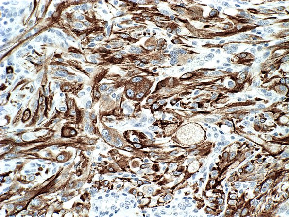 4B3 Pleomorphic xanthoastrocytoma (Case 4) GFAP a