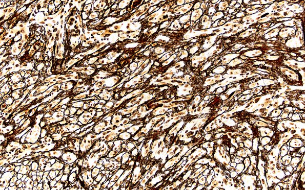 4C1 Pleomorphic xanthoastrocytoma (Case 4) Retic 20X