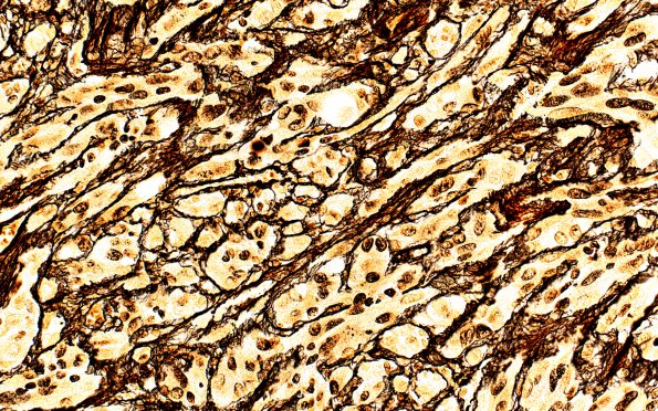 4C2 Pleomorphic xanthoastrocytoma (Case 4) Retic 40X