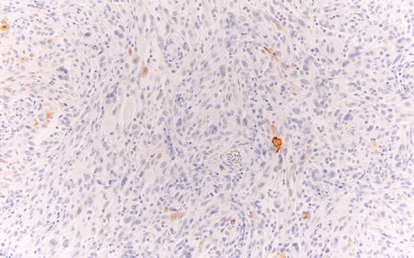 4D Pleomorphic xanthoastrocytoma (Case 4) SYN 20X