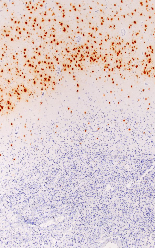 4E Pleomorphic xanthoastrocytoma (Case 4) NeuN 10X