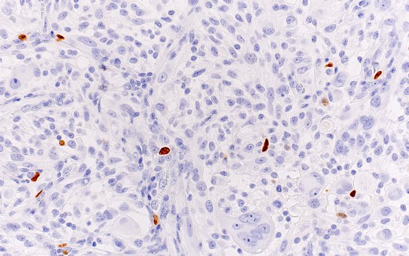 4G Pleomorphic xanthoastrocytoma (Case 4) Ki67 40X