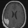 9A Xanthoastrocytoma, pleomorphic (Case 9) T1 W 1 - Copy