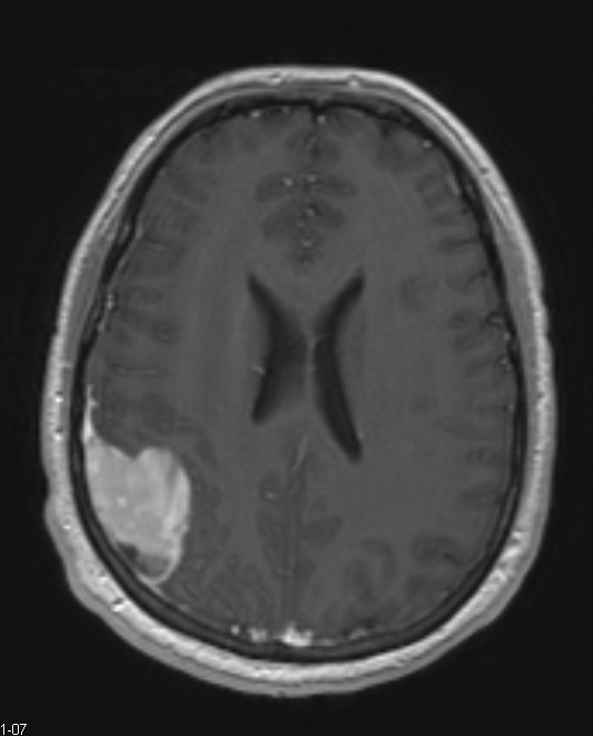 9A Xanthoastrocytoma, pleomorphic (Case 9) T1 W 1 - Copy