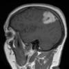 9A Xanthoastrocytoma, pleomorphic (Case 9) T1 W 3 - Copy