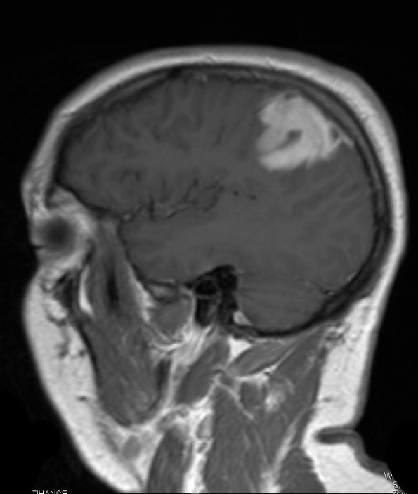 9A Xanthoastrocytoma, pleomorphic (Case 9) T1 W 3 - Copy