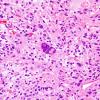 9B1 Xanthoastrocytoma, pleomorphic (Case 9) H&E 1.jpg