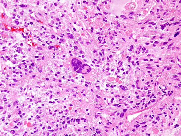 9B1 Xanthoastrocytoma, pleomorphic (Case 9) H&E 1.jpg