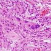 9B2 Xanthoastrocytoma, pleomorphic (Case 9) H&E 2.jpg