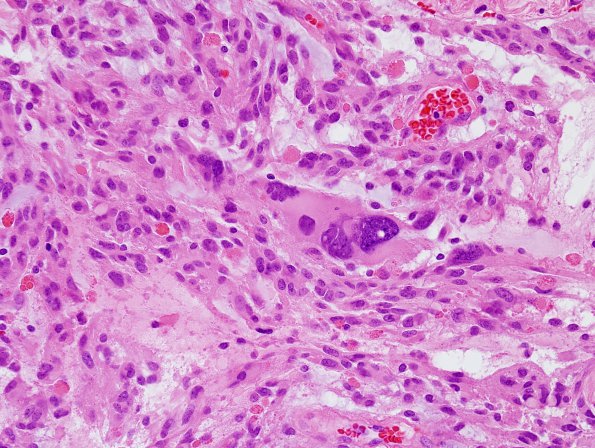 9B2 Xanthoastrocytoma, pleomorphic (Case 9) H&E 2.jpg