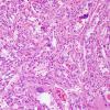 9B3 Xanthoastrocytoma, pleomorphic (Case 9) H&E 3.jp