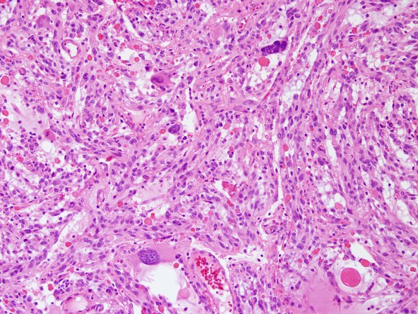 9B3 Xanthoastrocytoma, pleomorphic (Case 9) H&E 3.jp