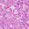 9B4 Xanthoastrocytoma, pleomorphic (Case 9) H&E 4.jpg