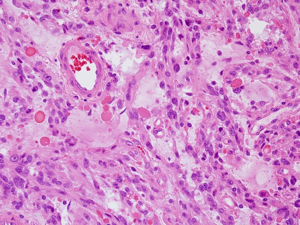 9B4 Xanthoastrocytoma, pleomorphic (Case 9) H&E 4.jpg