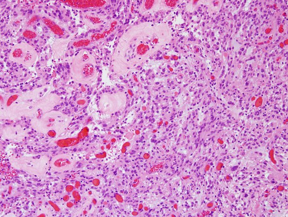 9B5 Xanthoastrocytoma, pleomorphic (Case 9) H&E 6.jpg