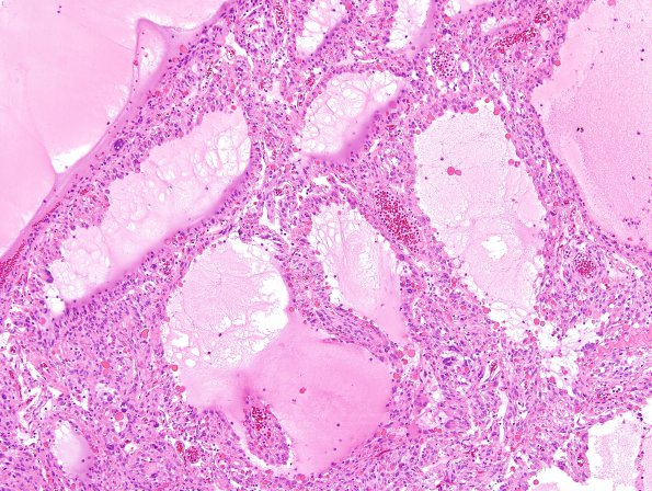 9B6 Xanthoastrocytoma, pleomorphic (Case 9) H&E 11.jpg