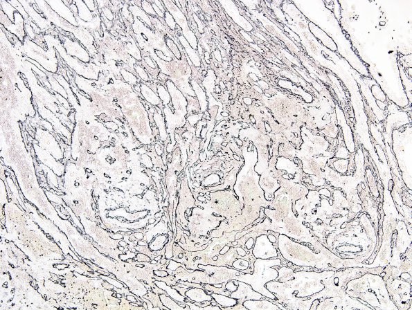 9D Xanthoastrocytoma, pleomorphic (Case 9) Retic 2.jpg