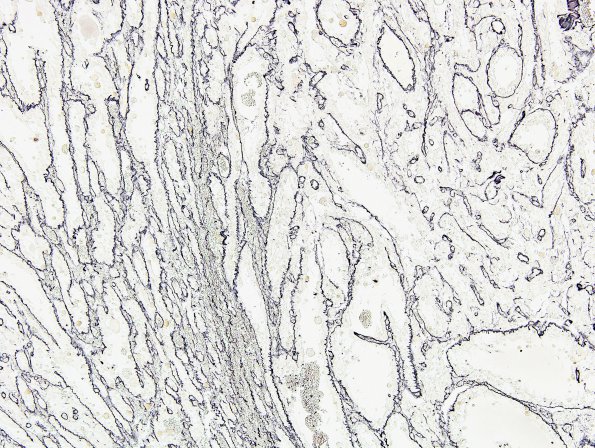 9D Xanthoastrocytoma, pleomorphic (Case 9) Retic 3.jpg