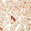 9E1 Xanthoastrocytoma, pleomorphic (Case 9) SYN 1.jpg