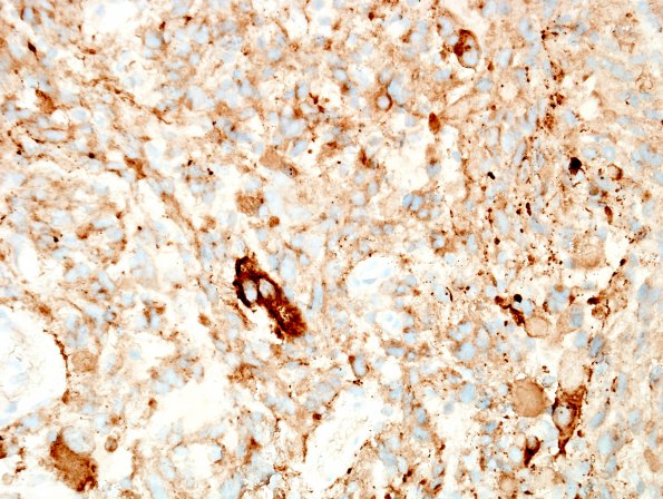 9E1 Xanthoastrocytoma, pleomorphic (Case 9) SYN 1.jpg