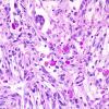 9F Xanthoastrocytoma, pleomorphic (Case 9) PAS 3.jpg