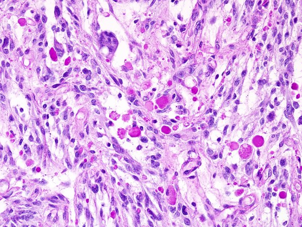 9F Xanthoastrocytoma, pleomorphic (Case 9) PAS 3.jpg