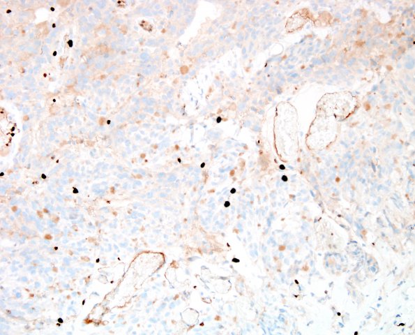 9G Xanthoastrocytoma, pleomorphic (Case 9) Ki67.jpg