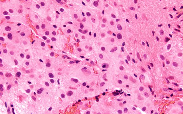 10A3 SEGA (Case 10) H&E 60X 2