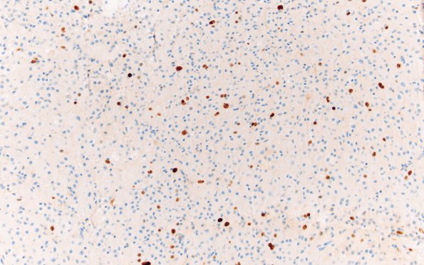 12D SEGA (Case 12) 20X Ki67