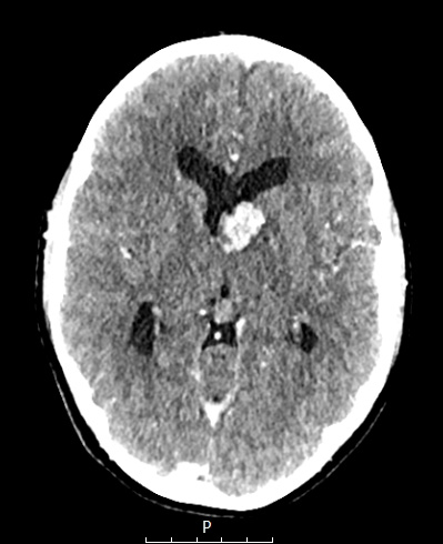 13A1 (Case 13) CT - Copy