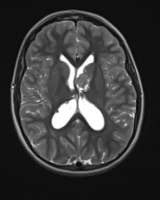 13A3 (Case 13) T2W - Copy